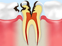 虫歯模式図