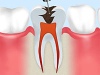 重度の虫歯