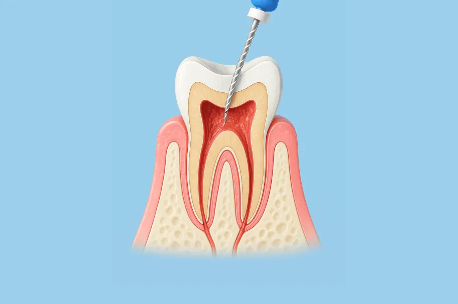 4.根管治療（歯の根の治療）