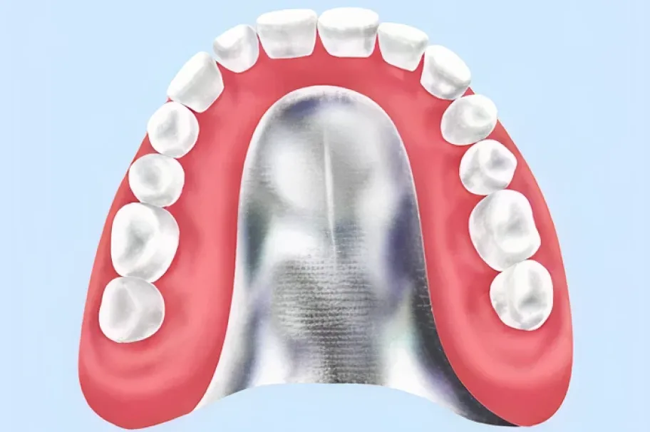 金属床義歯(自費)