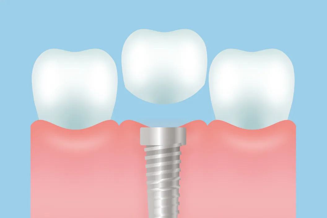 安定期間（結合期間）オッセオインテグレーション