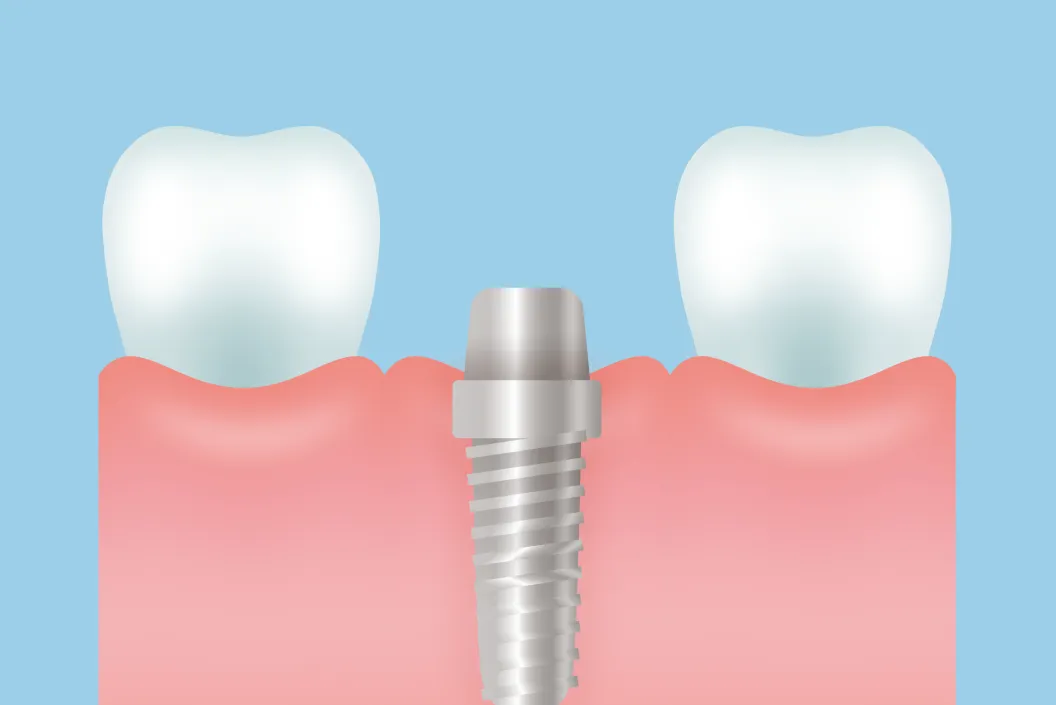 二次手術（アバットメント装着）