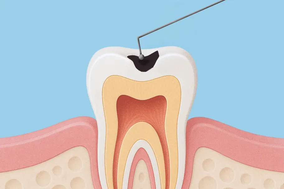 STEP 1歯を洗浄し削る