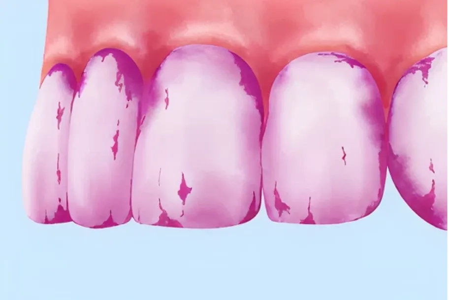 Sまずプラーク（歯垢）を染め出し、汚れのある部分をチェックします。