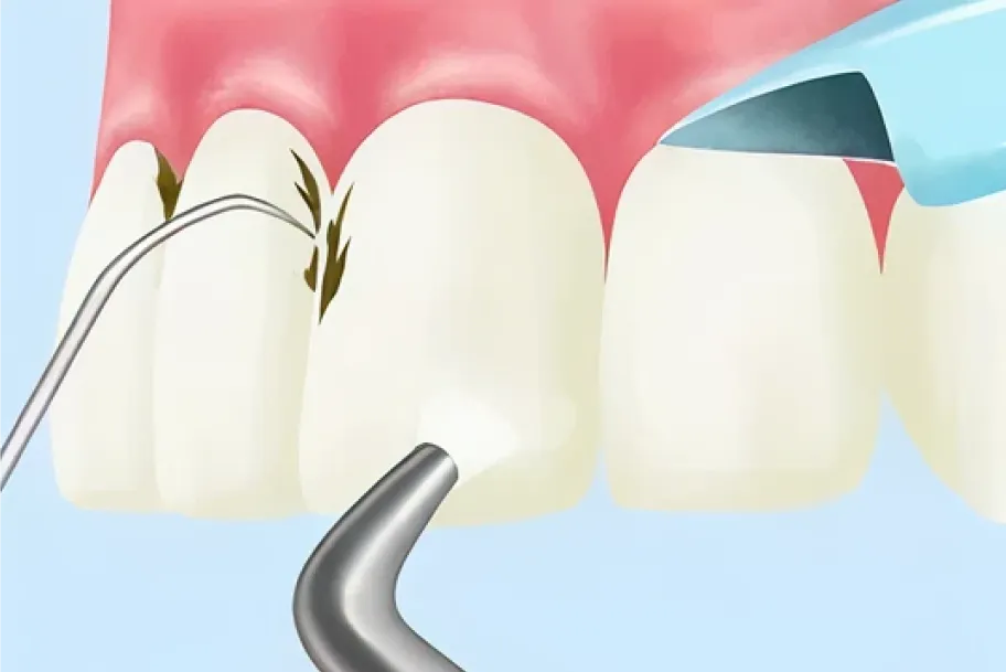 専用器具を使い、茶渋やヤニなどの着色を除去します。