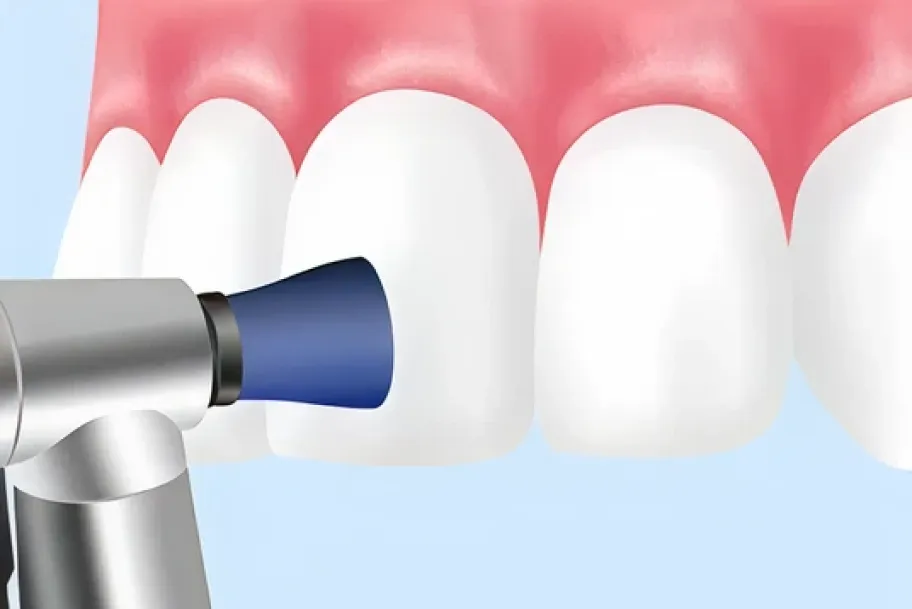 専用器具を使い、歯と歯の間や歯と歯ぐきの間の汚れを徹底的に除去し、歯をみがきあげます。