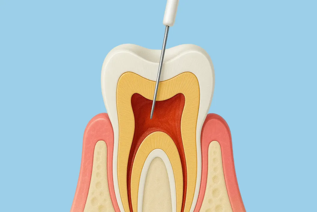 根管の長さを測定します。